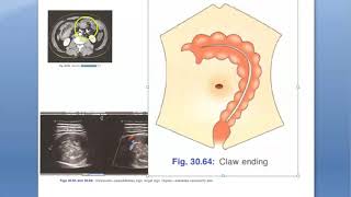 Surgery Intussusception Telescoping Intestine Child Peyer patch weaning rota virus red current jelly [upl. by Gonta275]