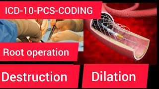 ICD10PCS codingRoot operation destruction amp dilation [upl. by Valerie]