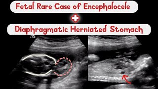 Rare Ultrasound Case of Fetal Encephalocele and Congenital Diaphragmatic Hernia [upl. by Ainez920]