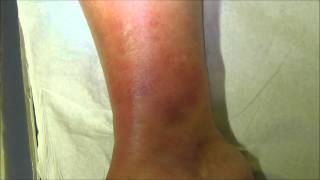 A case of tibial cellulitis before and 24 hours after treatment with antibiotics [upl. by Simeon]