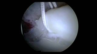 Hip Arthroscopy Labral Repair Surgery  Repair Torn Hip Labrum  Dr David J King [upl. by Ysteb]