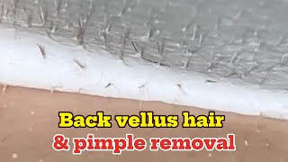 Back vellus hair amp pimple removal [upl. by Iznekcam]