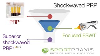 Stosswellentherapie ESWT in der regenerativen Medizin [upl. by Vivia296]