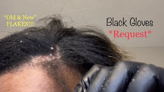 Dandruff Removal Dandruff Scratching Big Patch of Flakes amp Scabs off Scalp  Scalp Psoriasis [upl. by Ollehto458]