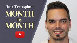 Heres How Your Hair Will Grow After Hair Transplant FULL TIMELINE [upl. by Egbert]