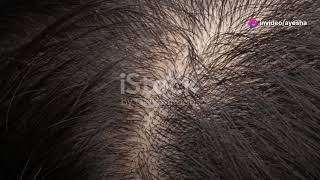 DHT Hormone The Hairfall Culprit Explained DHThairfallhaircareyoutubehair [upl. by Cirde]