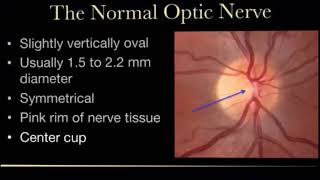 Glaucomatous Optic Disc Changes  DrSaad Alshamrani [upl. by Darken]