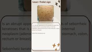 Leser–Trelat sign  seborrheickeratoses  Adenocarcinomas of the stomach [upl. by Rae]