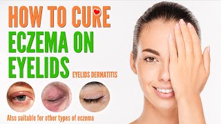 How to cure eczema on eyelids  Eyelids Dermatitis treatment and natural home remedies 2021 [upl. by Nohtan619]