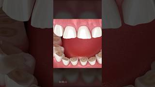 What Is Bruxism and How Is It Treated [upl. by Ttelrahc]