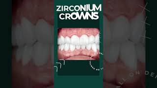 Zirconium Crown in Istanbul Before and after review  All On Dental Clinic Istanbul [upl. by Anaidirib]