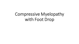 Compressive Myelopathy with Foot Drop [upl. by Aryhs]