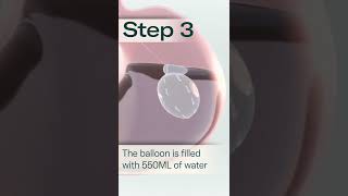 Allurion Gastric Balloon  A Simple Solution to Lasting Weight Loss [upl. by Nelyt]