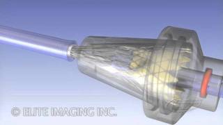 Loading Heart Valve Catheter  Medical amp Scientific Video Production [upl. by Ennovahs]