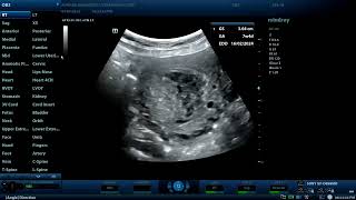 Partial hydatidiform mole Diagnostic ultrasound cases [upl. by Bastien]