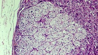 What is Hyperplasia  Pathology mini tutorial [upl. by Sinnelg]