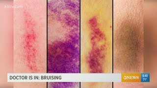 Why bruising matters and what the purple blue and yellow marks can indicate [upl. by Kurland548]