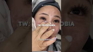 Skin treatments in Korea🥲✨🇰🇷 shorts koreanskincare beauty [upl. by Paolo]