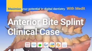 Clinical case  Anterior Bite Splint [upl. by Erv]