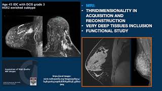 COMPARISON BETWEEN BMRI MAMMOGRAPHY DBT AND CESM [upl. by England549]