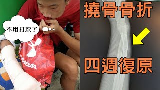 右手撓骨骨折，原本評估要2個月，現在四週就恢復正常  骨折治療記錄 [upl. by Sadnalor905]