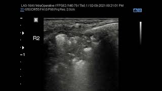 10  Pneumonia Dynamic fluid bronchogram [upl. by Hnirt]