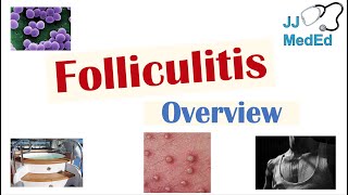 Folliculitis  Causes Bacterial Fungal Viral Risk Factors Symptoms Diagnosis Treatment [upl. by Brockie]