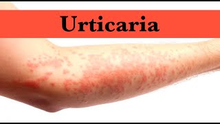 Urticaria by ASM Minds Team [upl. by Rihsab]