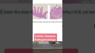 Coeliac diseaese pathophysiology شرح بالعربي [upl. by Gudren]