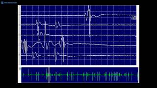 Kimura amp Kohara F32 Typical fasciculation potentials [upl. by Killam385]