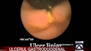 ULCERUL GASTRODUODENAL [upl. by Yert904]