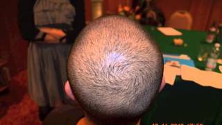 FUE Hair Transplant Hairline Clinic in Turkey 3519 GRAFTS FUE [upl. by Nnyleuqaj]