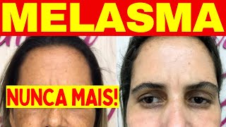 MELASMA  Como Acabar Com MELASMA NO ROSTO Caseiro FÓRMULA AMERICANA [upl. by Reel]