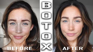 BOTOX TREATMENT BEFORE amp AFTER [upl. by Merle]