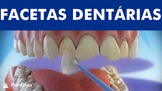 Facetas dentárias  Preparação e colocação de facetas © [upl. by Cthrine]