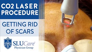 CO2 Laser Resurfacing Treatment For Getting Rid of Scars  Full Procedure [upl. by Aremat]