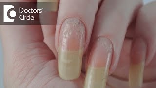 What can cause deep holes in nails amp is it related to stress  Dr Nischal K [upl. by Annoyed860]