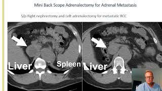 Interesting case of the week 8272021 Adrenal Metastasis [upl. by Landers]