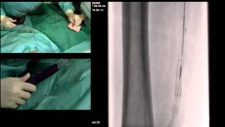 TSR SEGMENTAL RECANALIZATION WITH SUPERA STENTING OF SFA amp POPLITEAL ARTERY AND RECANALIZATION AND P [upl. by Eilzel]