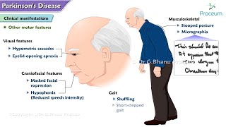 Parkinsons Disease🧠  Etiology  Pathophysiology  Clinical manifestations  Diagnosis  Treatment [upl. by Esimaj]