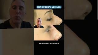 NonSurgical Nose Job [upl. by Ronnica]