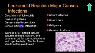 LEUKEMOID REACTION 4TH YR [upl. by Atsedom]