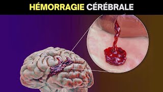 Que se passetil en cas dhémorragie cérébrale  Symptômes causes et traitement [upl. by Airamesor469]