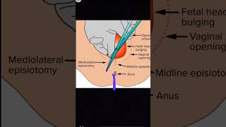 Obstetrics Episiotomy types viva [upl. by Katherina399]