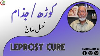 JAZAM KI BEMARI KORDH LEPROSY KA ILAJ BY HAKEEM ABBAS ALI hakeemabbasali [upl. by Crescint]