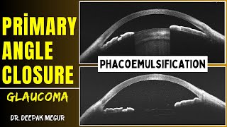 Primary angle closure glaucoma  Phacoemulsification  Dr Deepak Megur [upl. by Nylecoj]