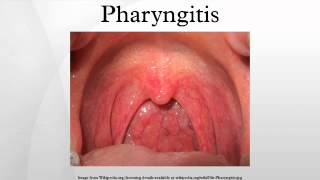 Pharyngitis [upl. by Cheston959]