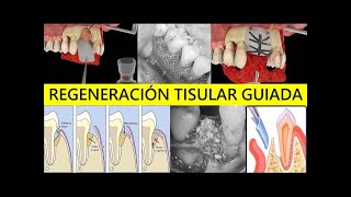 FUNDAMENTOS Y BASES QUIRÚRGICAS DE LA REGENERACIÓN TISULAR GUIADA RTG [upl. by Grodin]