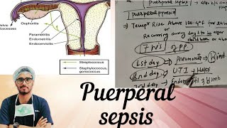 Puerperal sepsis part 1 [upl. by Zacharia]