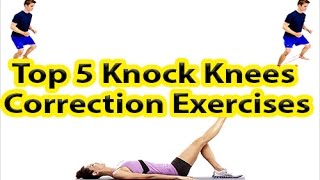 Top 5 Knock Knees Correction Exercises [upl. by Brighton]